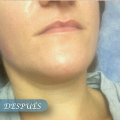 Punta Diamante Resultado en Salón de Belleza Goya Málaga